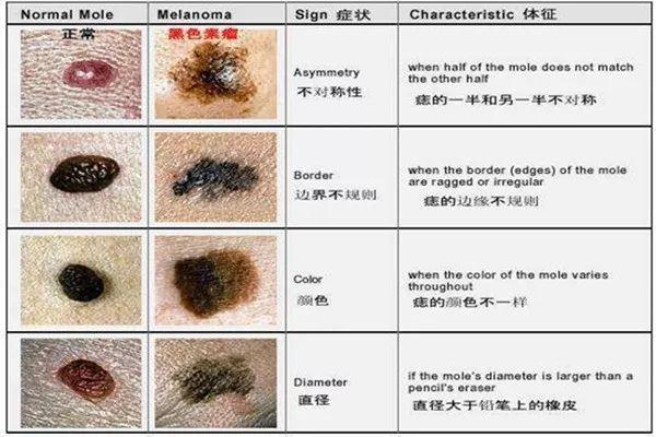 赶快检查!宝宝身上有这4种胎记或痣,要立刻就医! - 知乎
