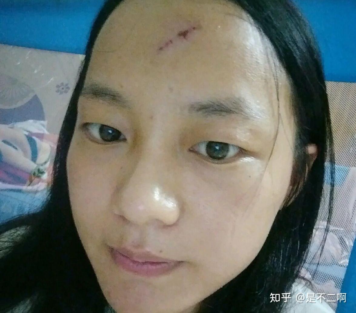 被医生判定脸上永久留疤,但我却用医用硅酮拯救了我自己,真实记录磕伤疤2个月淡化 - 知乎