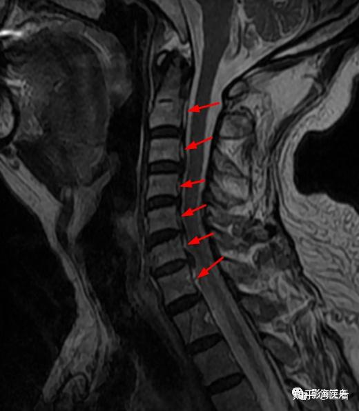典型病例颈椎后纵韧带钙化mr