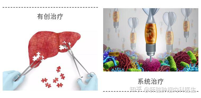 晚期肝癌患者如何选择适合自己的治疗?