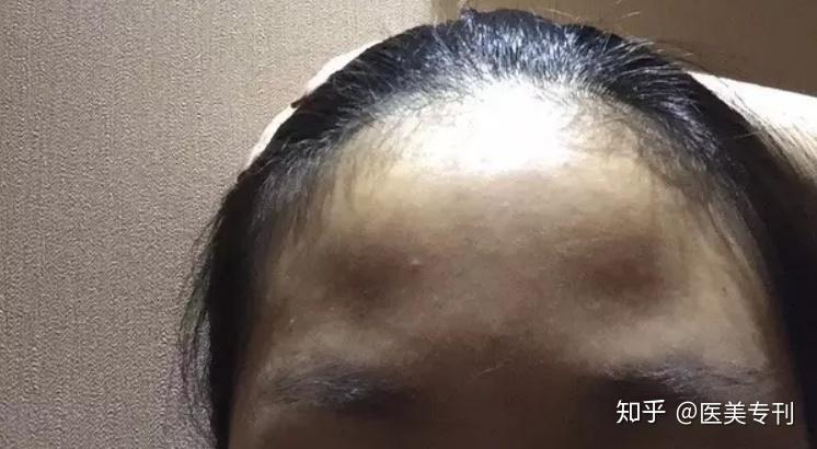 听我做超声刀后的真实感觉超声刀毁容图片探讨