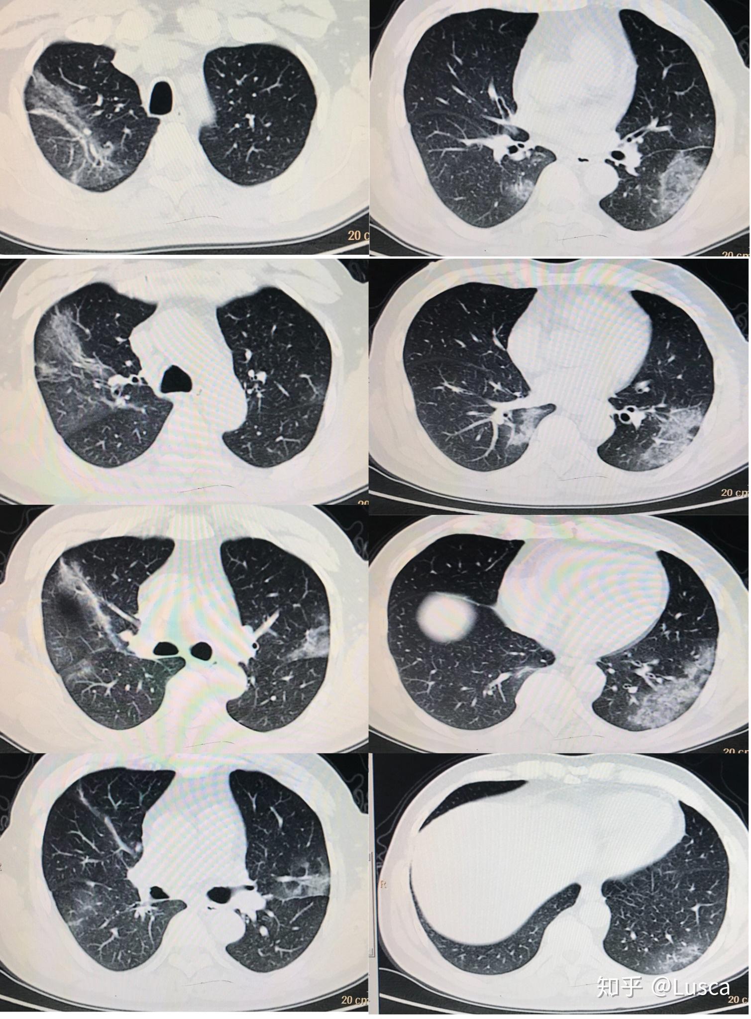 新冠肺炎的肺CT图片图片