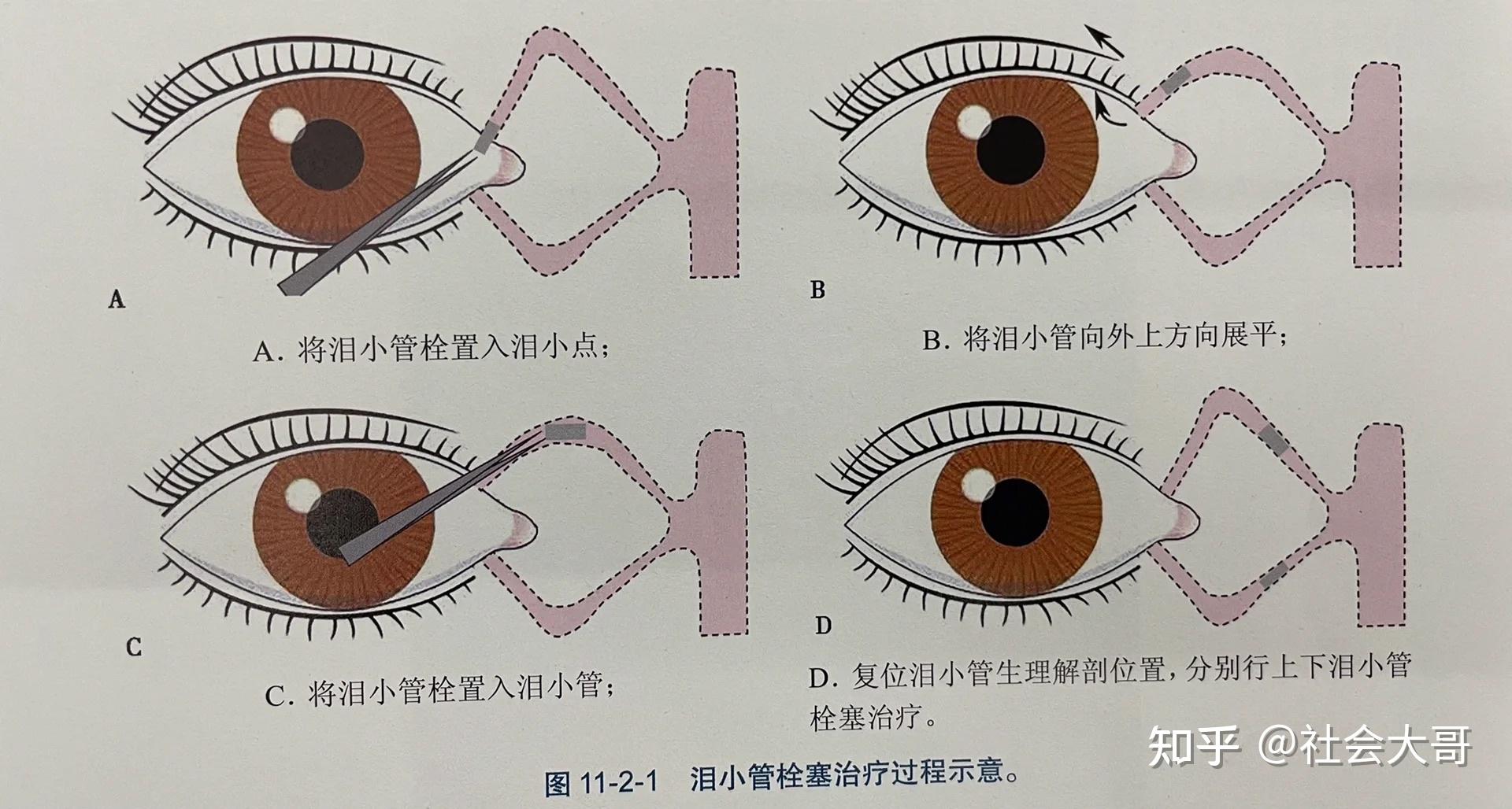 干眼症｜泪小点手术你不知道的③件事 - 知乎