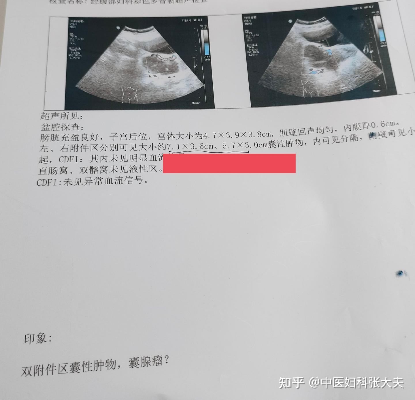 盆腔炎发热,双附件大囊肿,汤药20多天,退热,囊肿基本消失 - 知乎