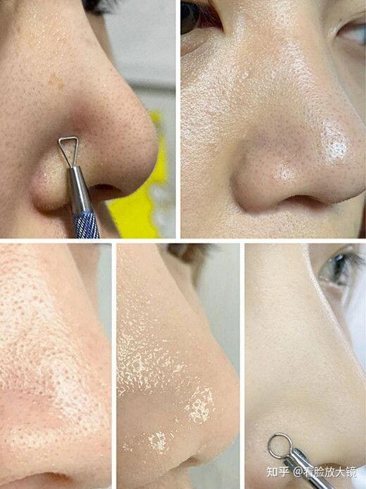 可以用什么去黑头 v2-00b95e1ab4ebe71ba51532d9c4cae2a5_r.jpg