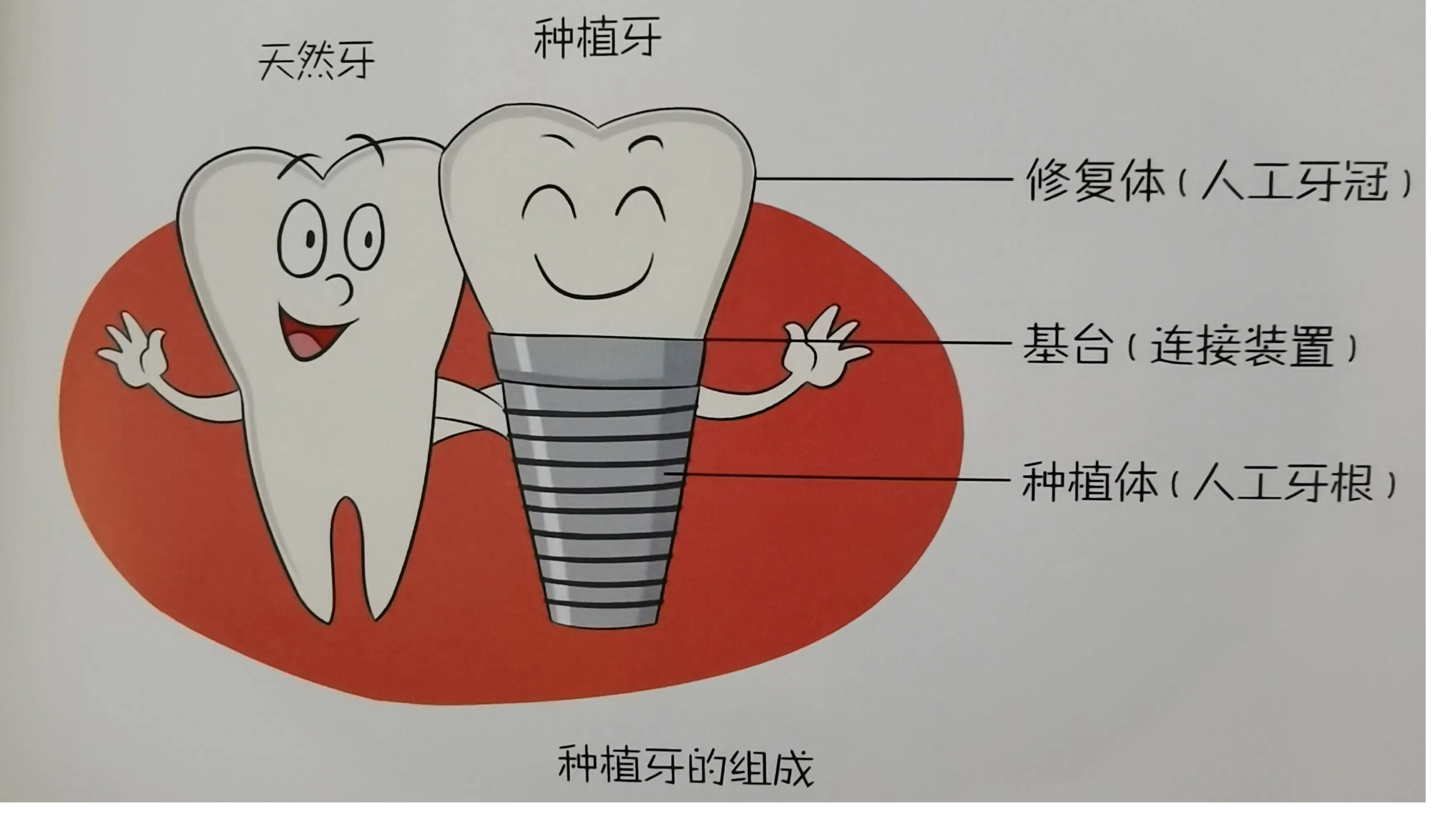 种植牙的寿命是多久，一般能用几年？ | 升艺口腔医院
