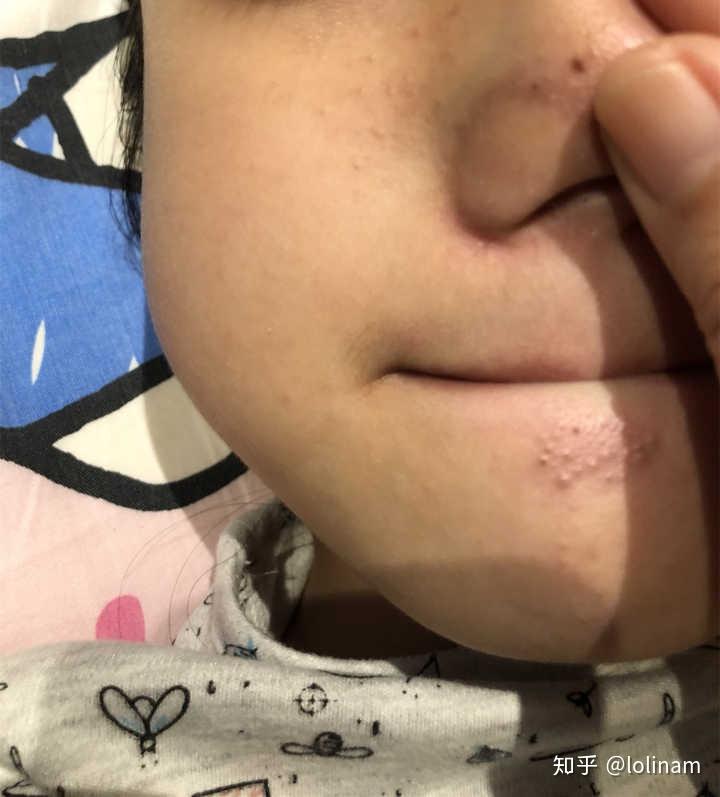 下巴上密密麻麻的白点点到底是什么? - 知乎