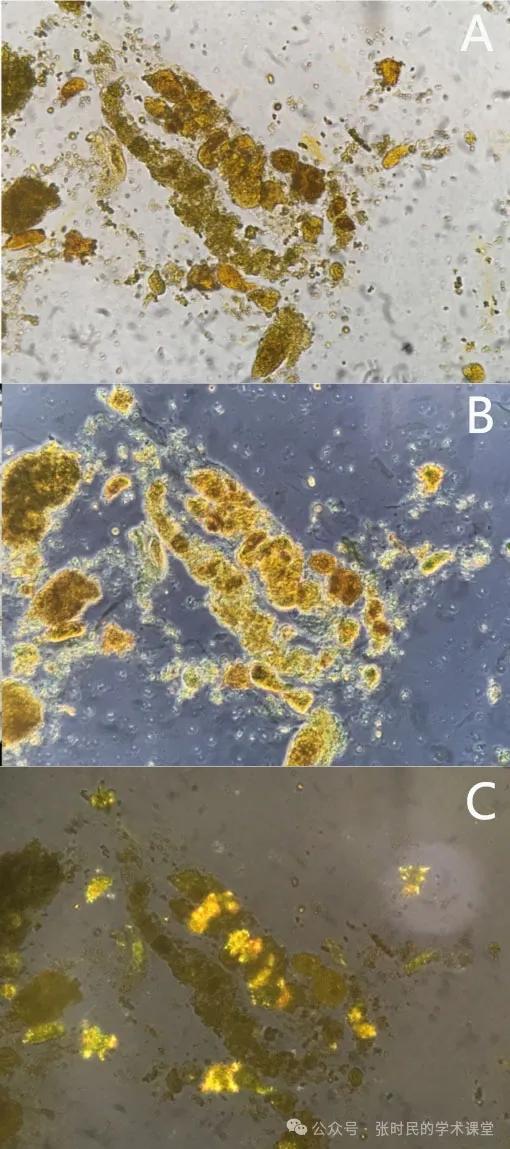 专家解读尿液中这种管型的特征