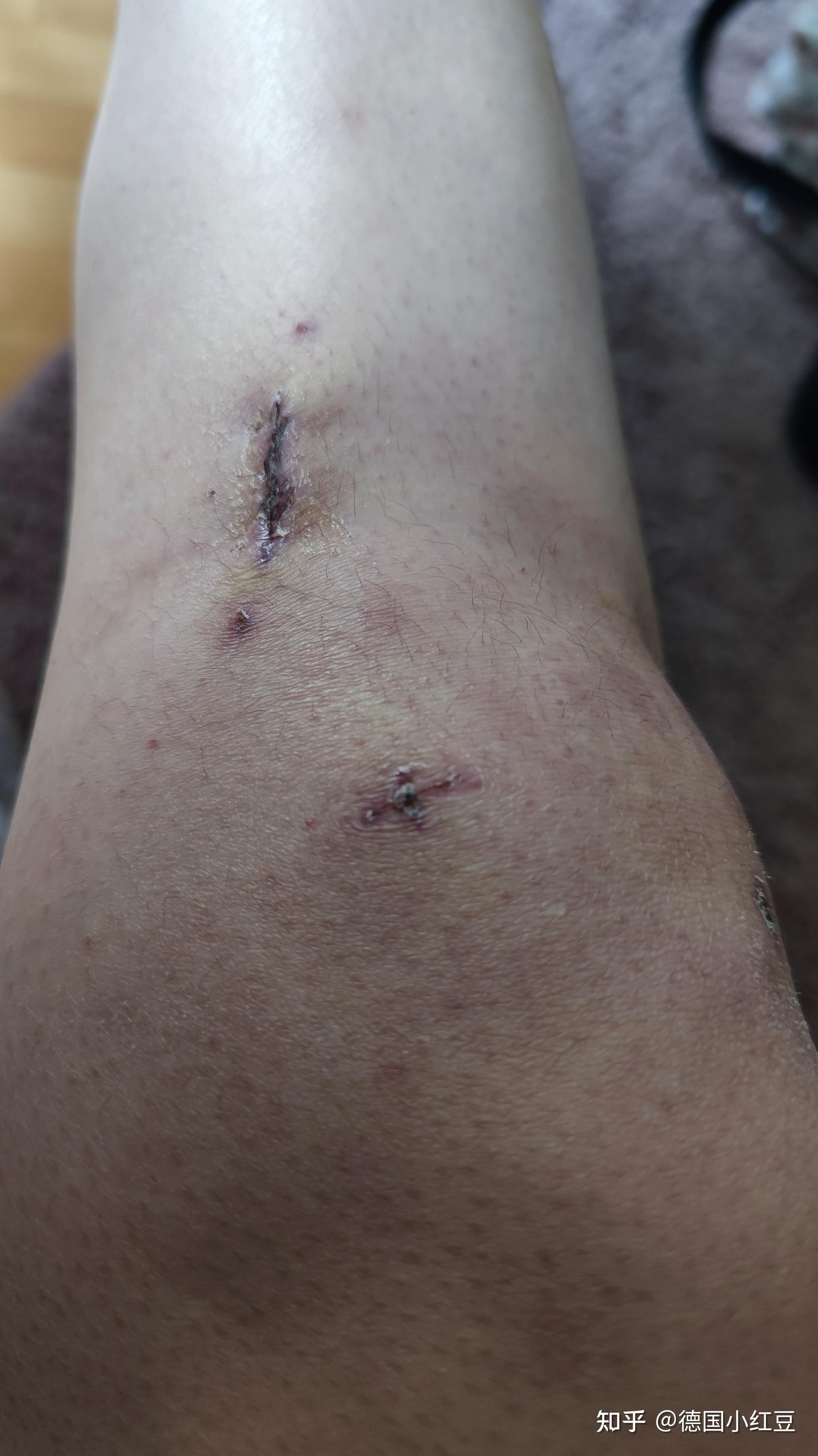 在德国最好的骨科医院,做前交叉韧带重建手术全过程记录 - 知乎