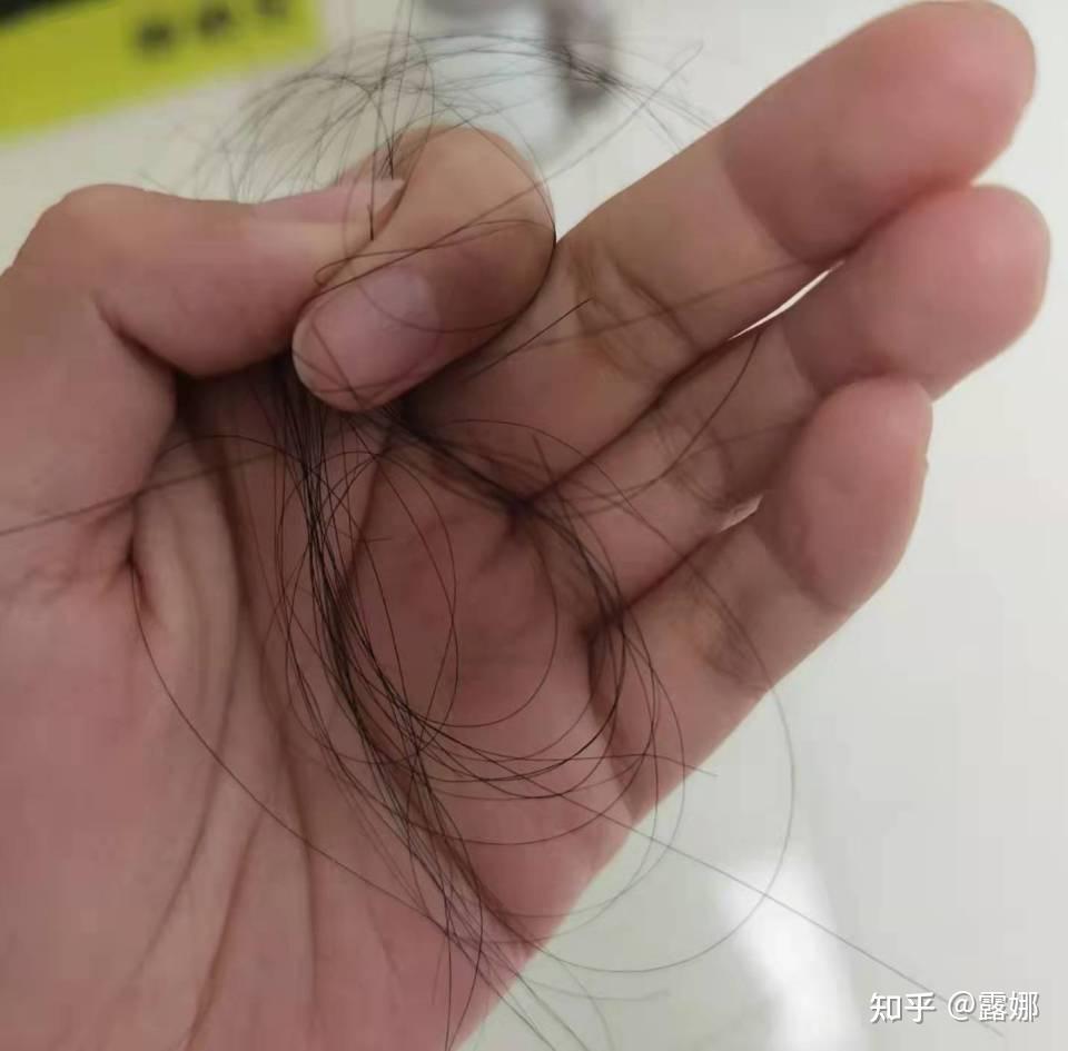 一,【脱发福音 秃头救命水】