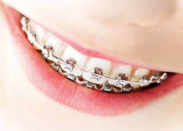 吐血整理人人都想知道的固定矫治器看这里