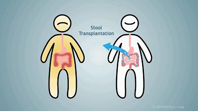菌群移植常见的几种方式简介 - 知乎