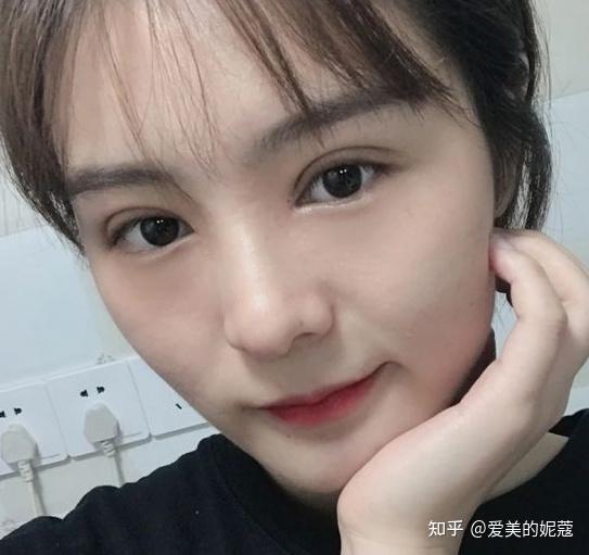 天津最自然的全切双眼皮,好看又不贵