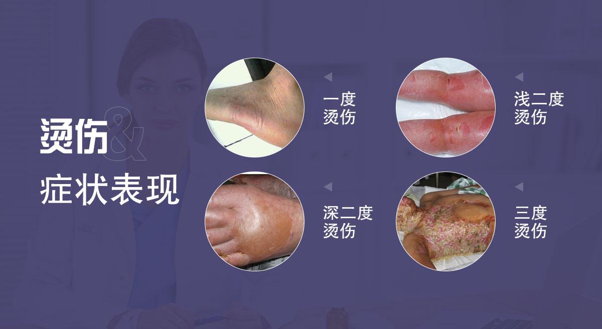 烫伤 不同程度 症状表现 知乎 烫伤 不同程度 症状表现 知乎