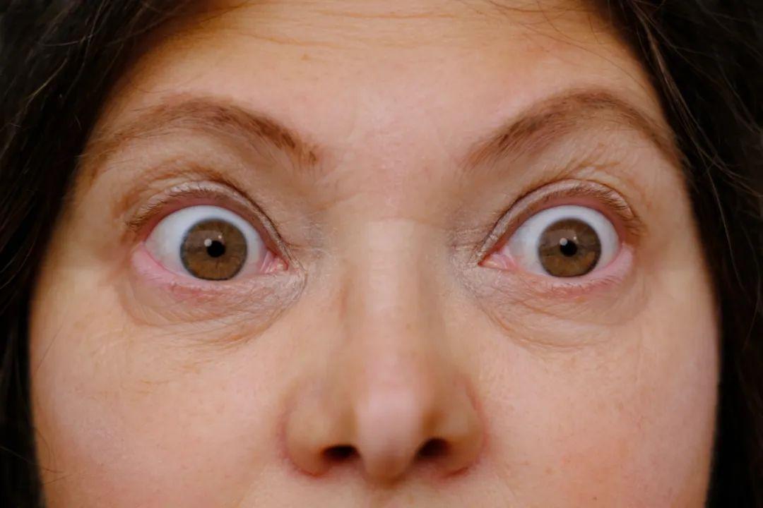 甲状腺相关眼病发展到中重度的时候,患者会有眼球明显突出,畏光,流泪