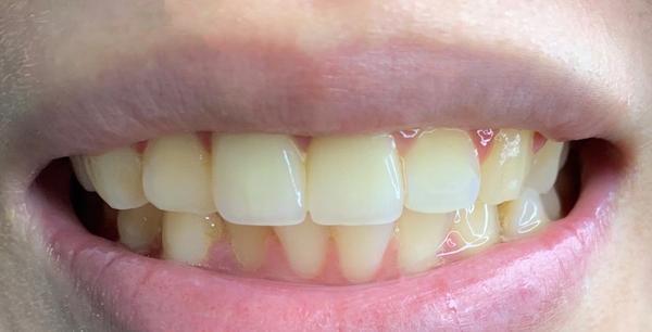 我天天刷牙,可是牙齿还是有点发黄,有什么好的办法可以使牙齿变白?