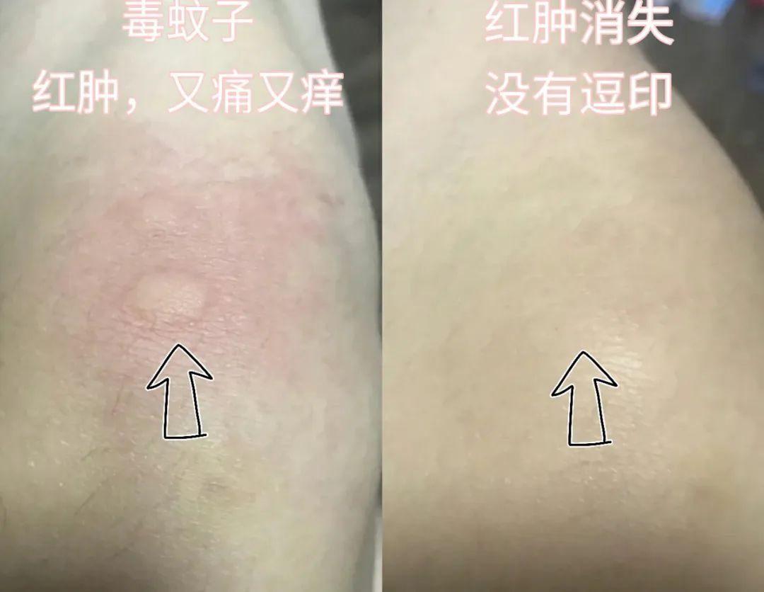 蚊痱喷雾喷一喷蚊子立马逃叮咬后能止痒不留疤孕婴安心用