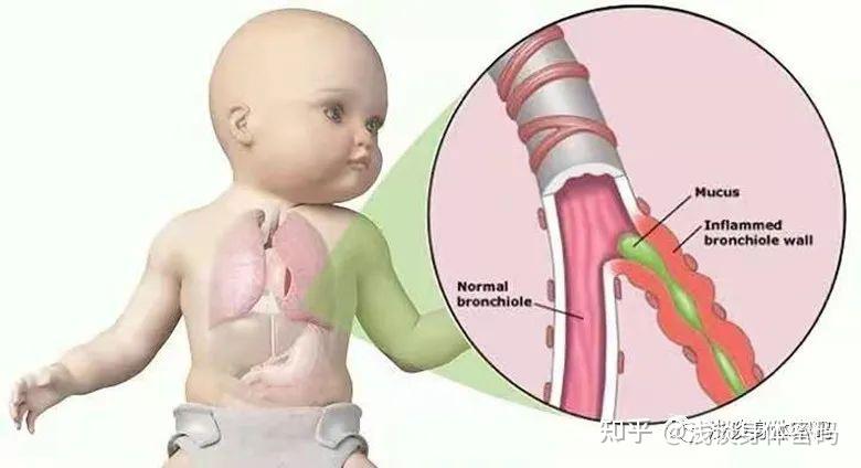 新生儿喉软骨图片