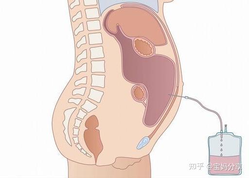 卵巢過度刺激對試管有影響嗎? - 知乎