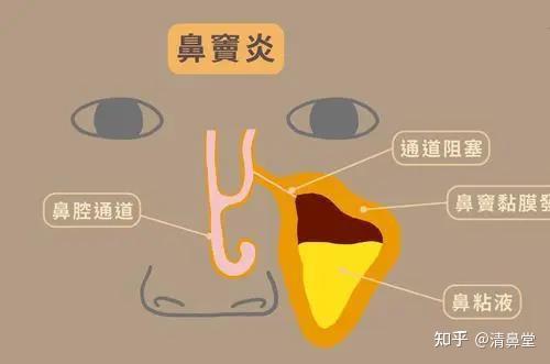 鼻窦炎是什么?鼻窦炎的危害有哪些？ - 知乎