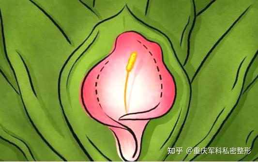 小阴唇整形在近几年外阴女性私密整形中比较火爆,而且上升数量呈井喷