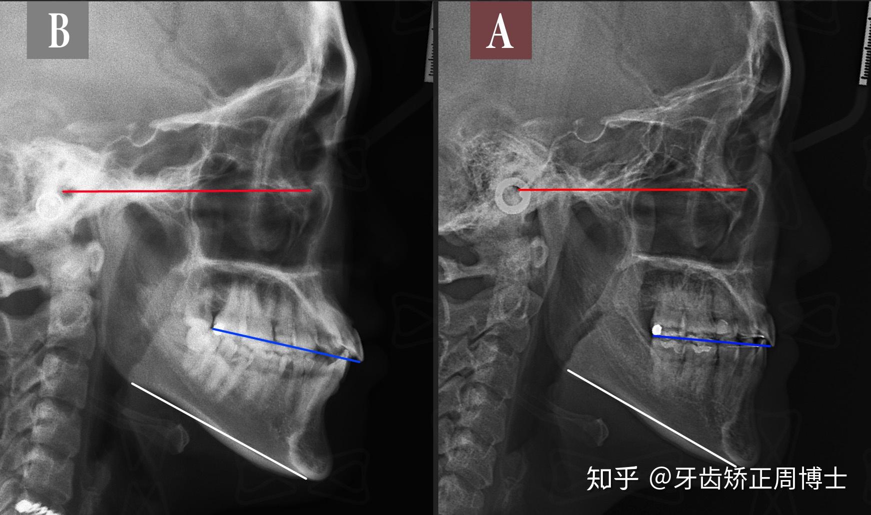 上颌前突下巴后缩露牙龈矫正案例