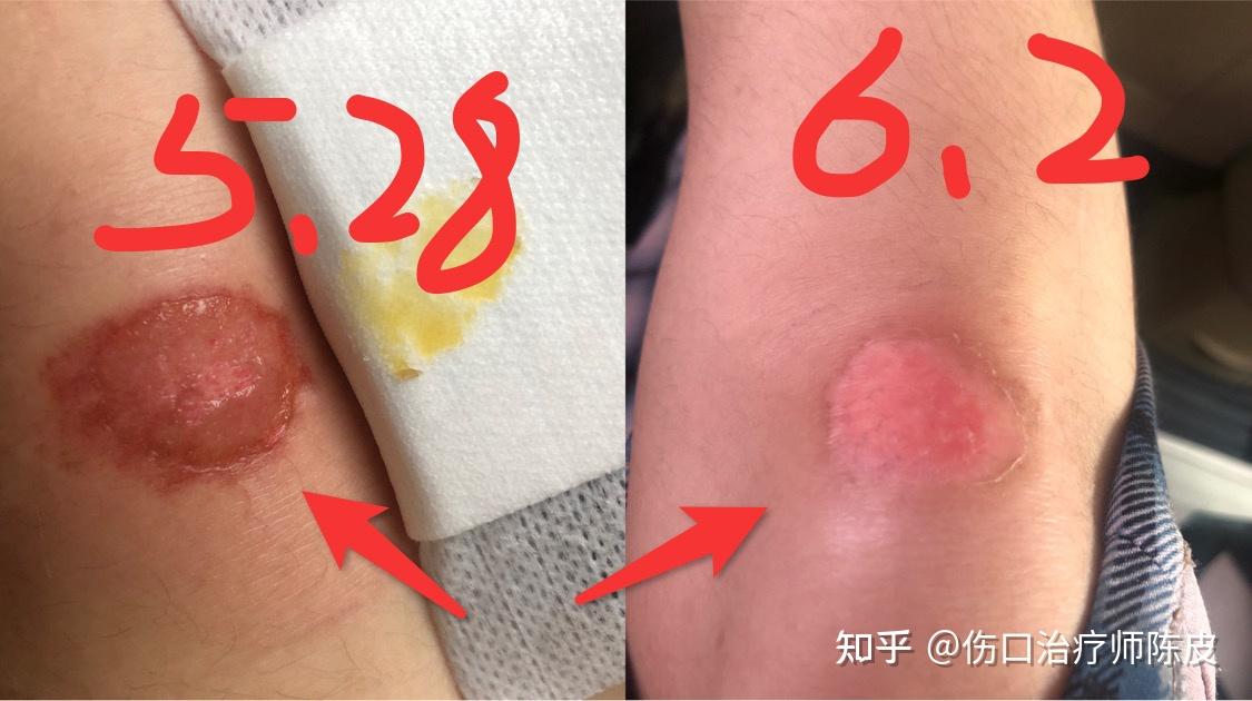 擦伤-长期用红霉素软膏不靠谱,抗生素千万别再滥用啦! - 知乎