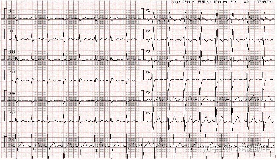 心电图图谱丨二尖瓣型p波,左心房异常 