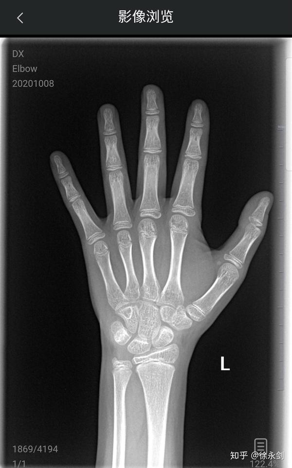 性发育与骨龄不同也可能存在难长高