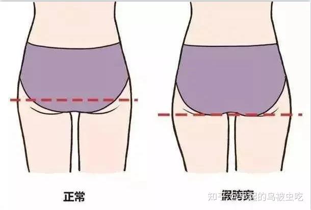 瘦大腿可以间接提升臀线拉长双腿齐永乐院长为您讲述原因