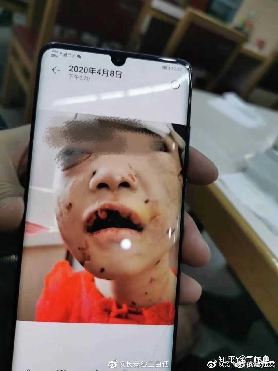 黑龙江佳木斯虐童案再一次年幼的孩子惨遭魔爪