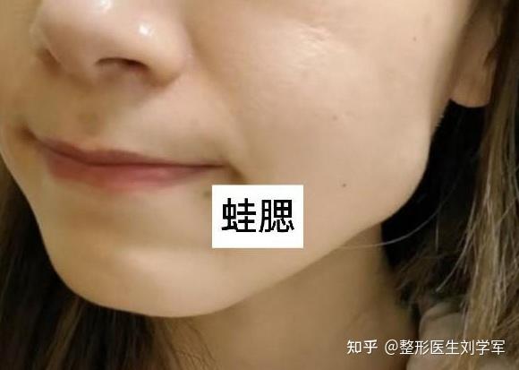 注射肉毒素后出现蛙腮怎么解决? - 知乎