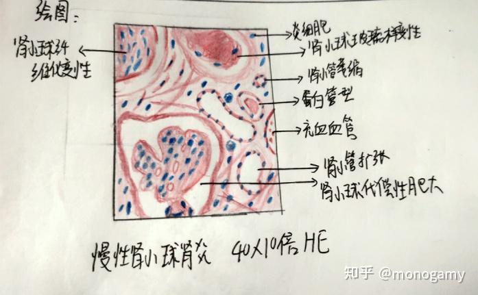 小叶性肺炎绘图及标注图片