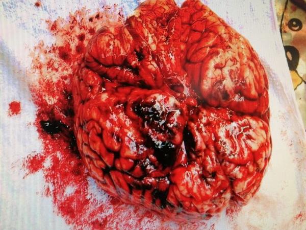 深入大脑,讲讲蛛网膜下腔出血.