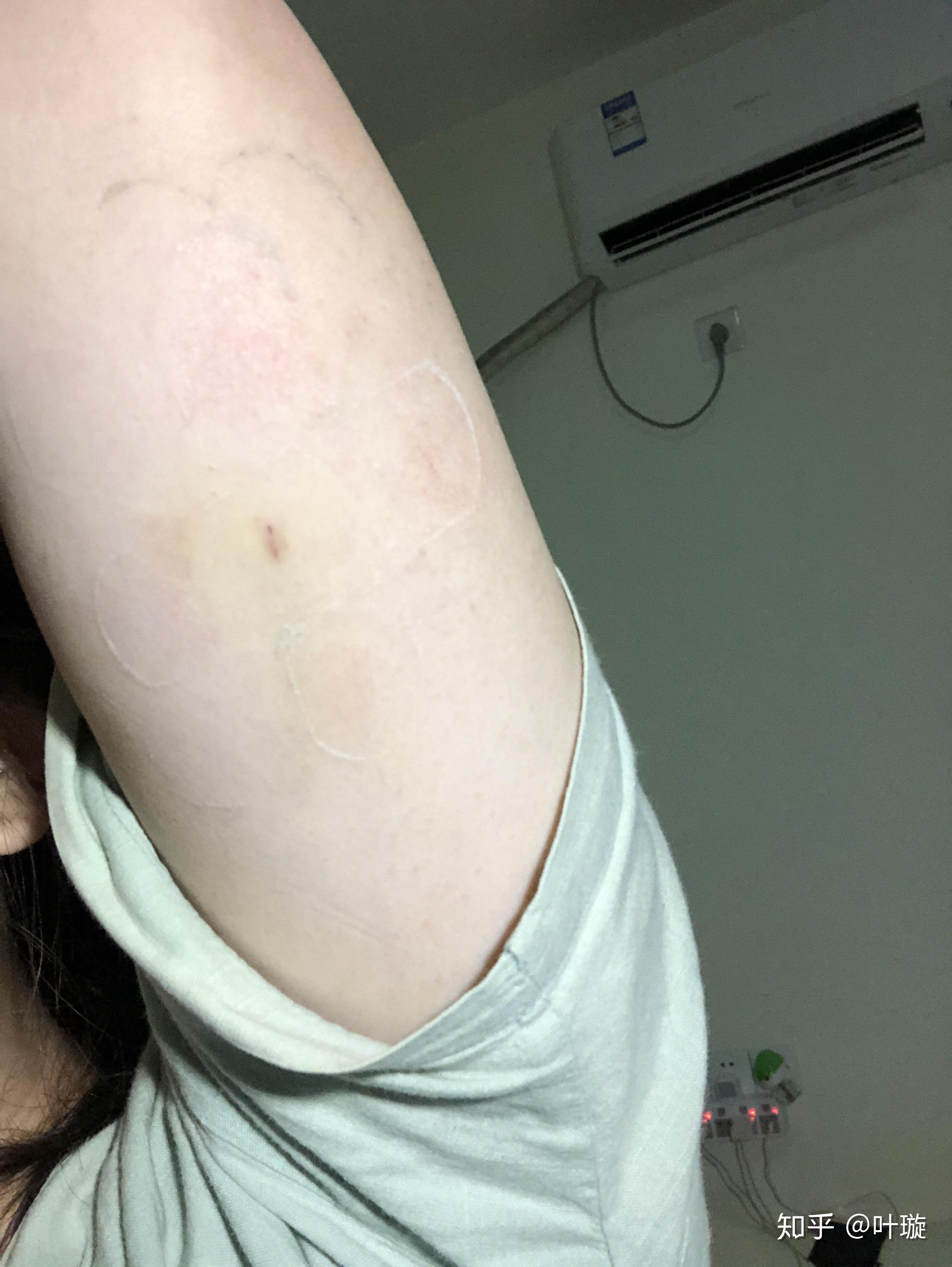 有小伙伴试过皮下埋植避孕法(implant)吗?是怎么样的体验?
