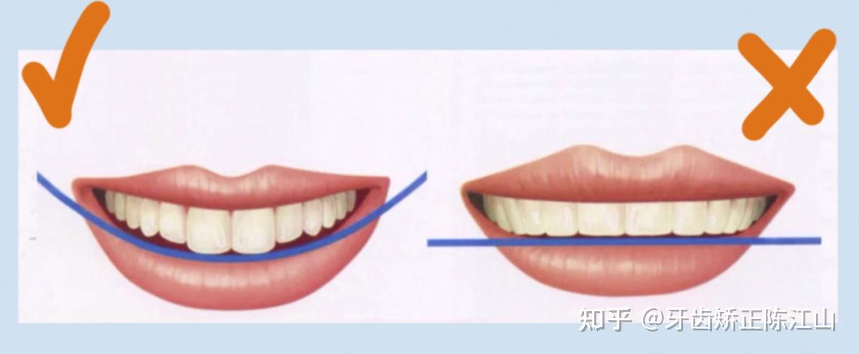 牙齿矫正丨笑线是什么？如何获得？ - 知乎