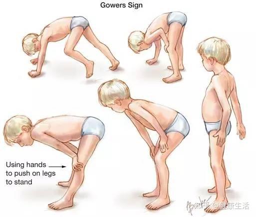 肌肉一天天的萎缩最终会夺走他们的行动能力进行性肌营养不良