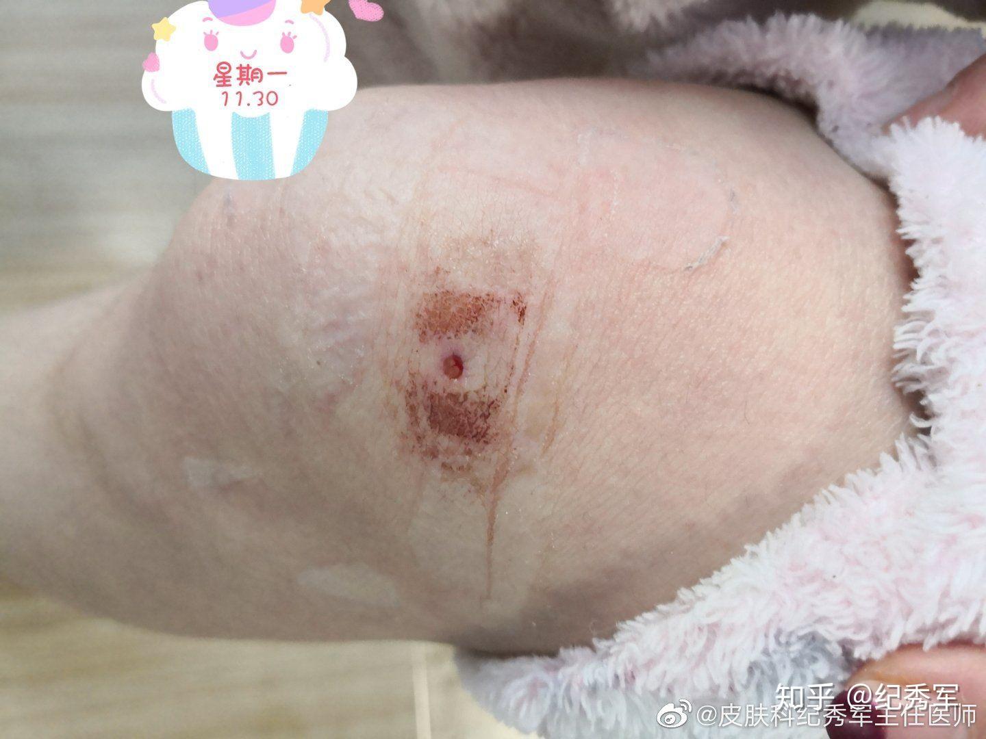 环钻治疗色素痣（不缝线）治疗前后对比图 - 知乎