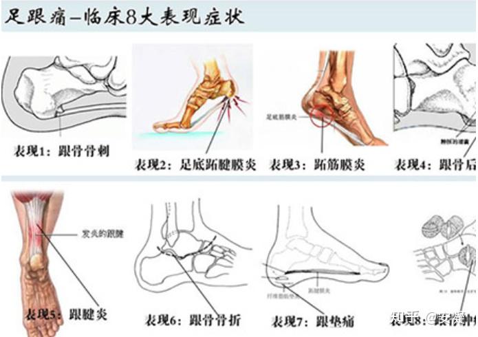 足跟痛