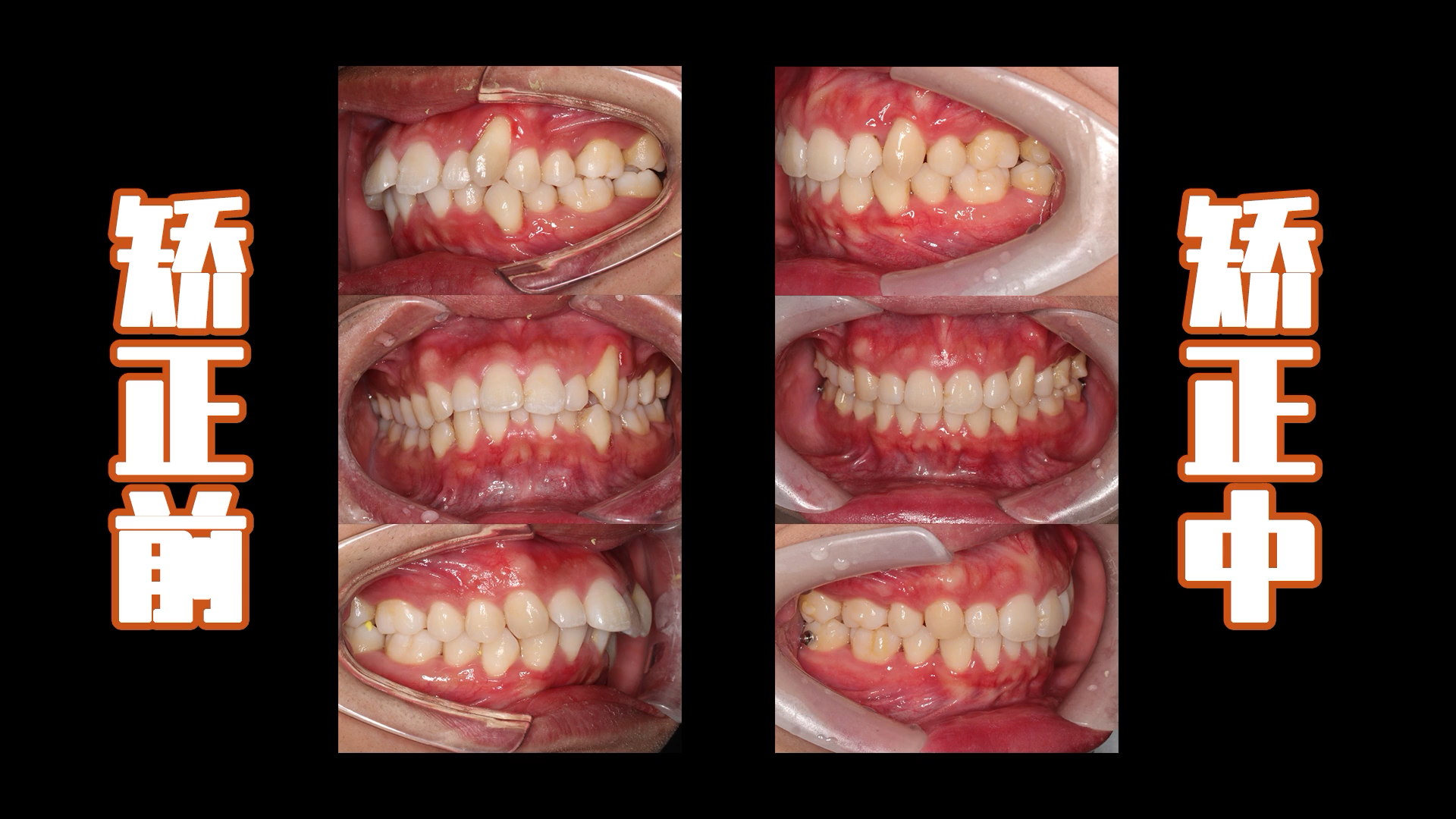 案例分享:前牙唇倾扭转中线不齐矫正