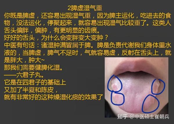 齿痕重就是脾虚吗？自己的脾虚在哪个阶段？9种脾虚一次讲明白 - 知乎