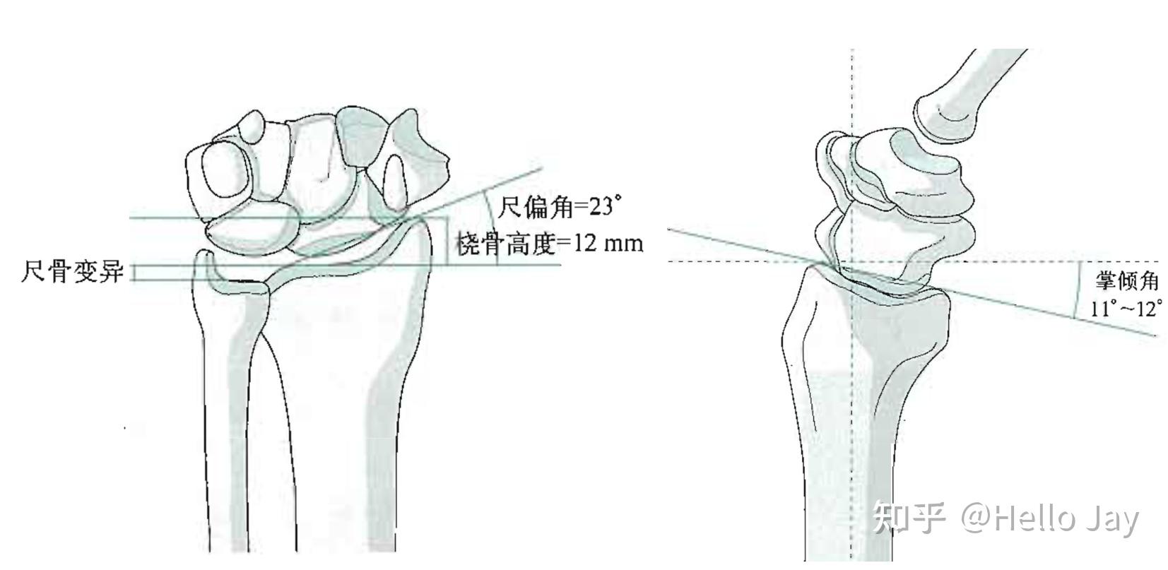 桡骨分水岭解剖图图片