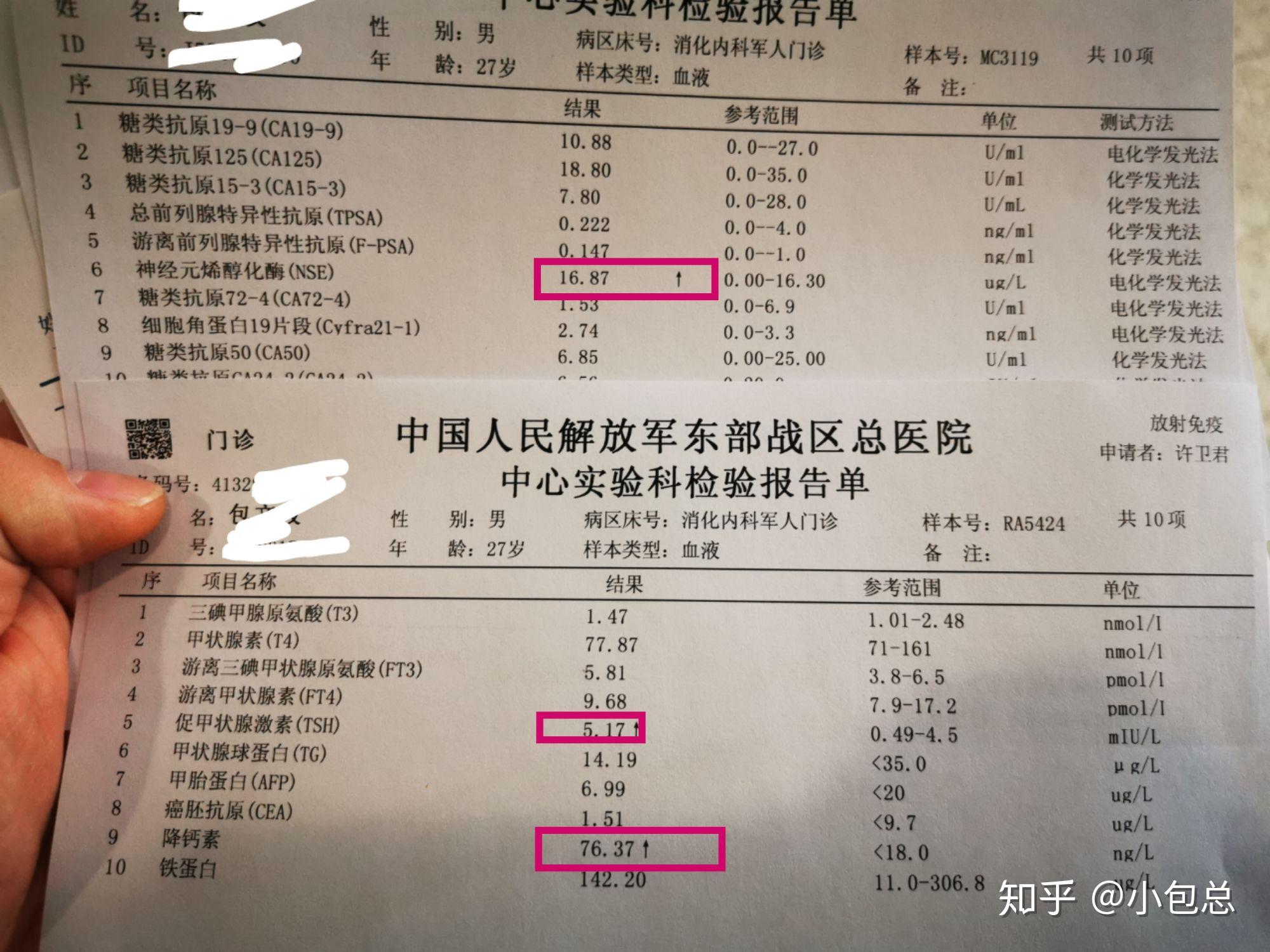 血液中降钙素76远高于正常值18的上限促甲状腺激素52也高于正常值的45