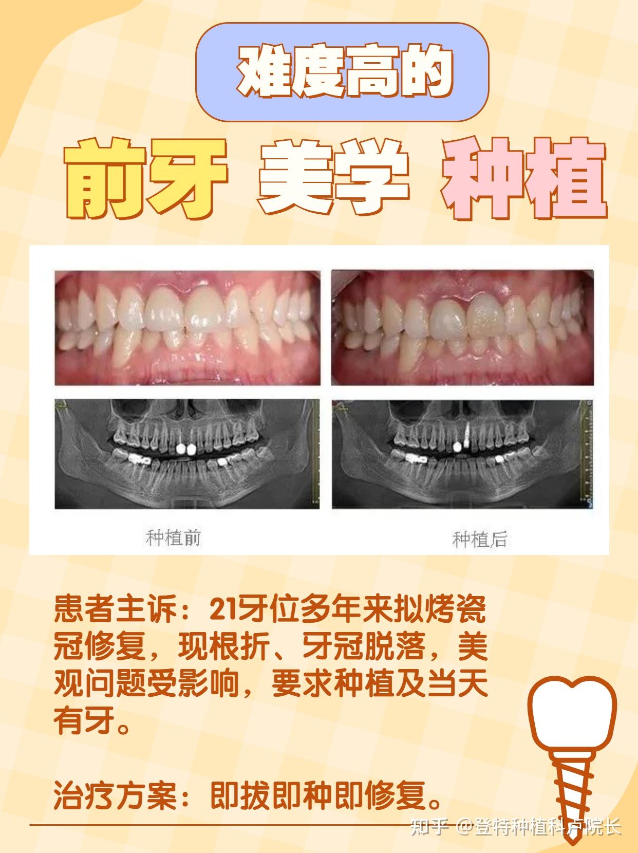 产品介绍--上海雷帕罗义齿