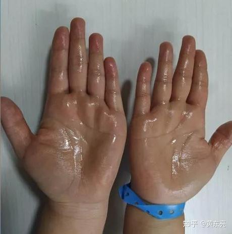 手脚出汗怎么治疗