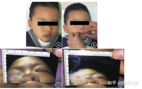 一,为什么口呼吸会造成这么严重的后果?