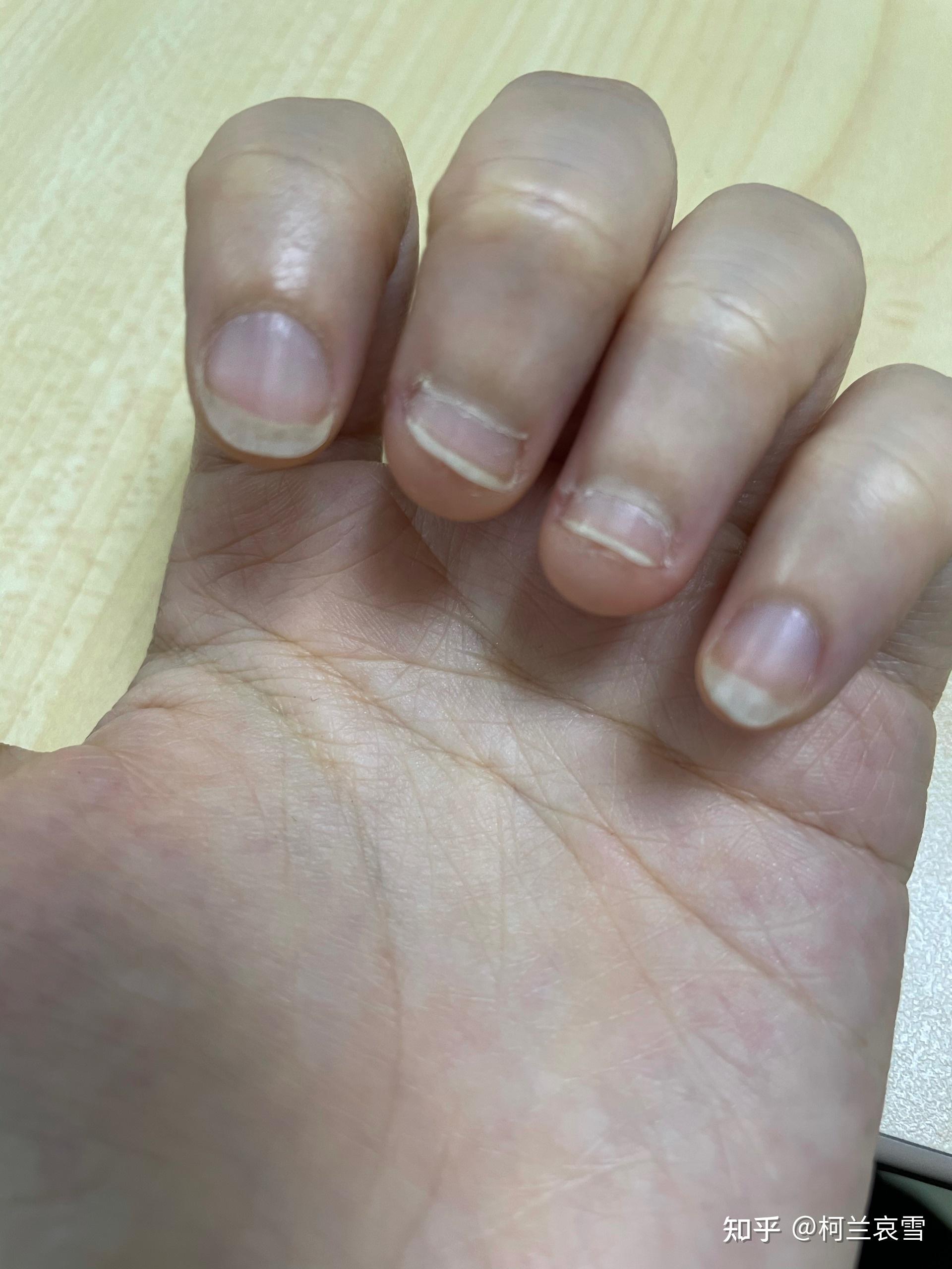 我是怎么治疗指甲凹凸不平、手指脱皮的现象 - 知乎