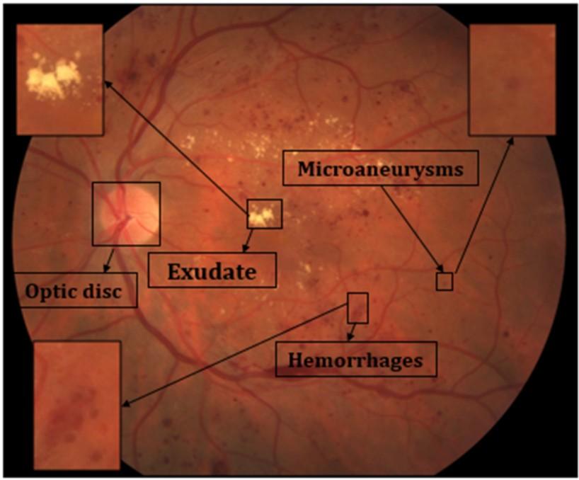 医疗影像小目标检测从眼底病变检测说起