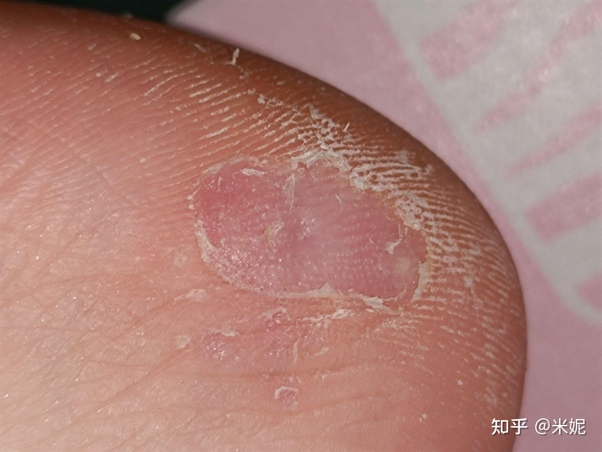 冷冻治疗记录有图
