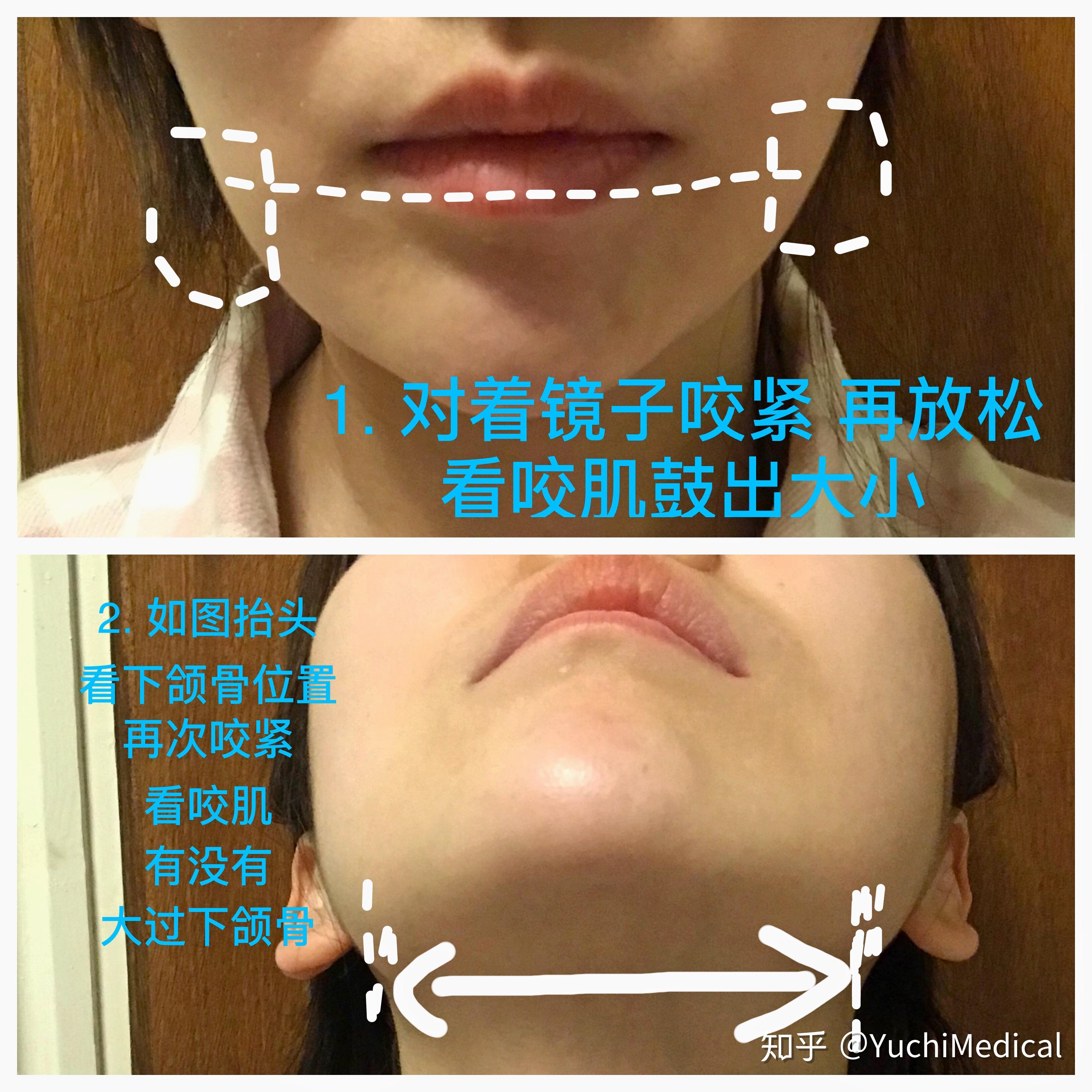瘦脸针咬肌会完全消失吗_瘦脸针咬肌多久变软_咬肌瘦脸针